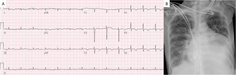 This composite diagnostic image features two panels related to a cardiovascular assessment. Panel A shows a 12-lead Electrocardiogram (ECG) demonstrating a normal sinus rhythm. A key finding is the low voltage QRS complexes globally across both limb and precordial leads, which can be clinically associated with conditions such as pericardial effusion or obesity. Panel B is a posterior-anterior (PA) chest X-ray exhibiting a significantly enlarged cardiac silhouette, resulting in a 'water bottle' heart shape often characteristic of massive pericardial effusion. There is a notable increase in the cardiothoracic ratio. The lung fields show some patchy opacities potentially suggesting mild pulmonary congestion or edema. Radiopaque medical monitoring leads are visible over the thoracic region. Together, these images illustrate the classic findings of pericardial effusion: dampened electrical activity on ECG and a globose cardiac shadow on radiography.