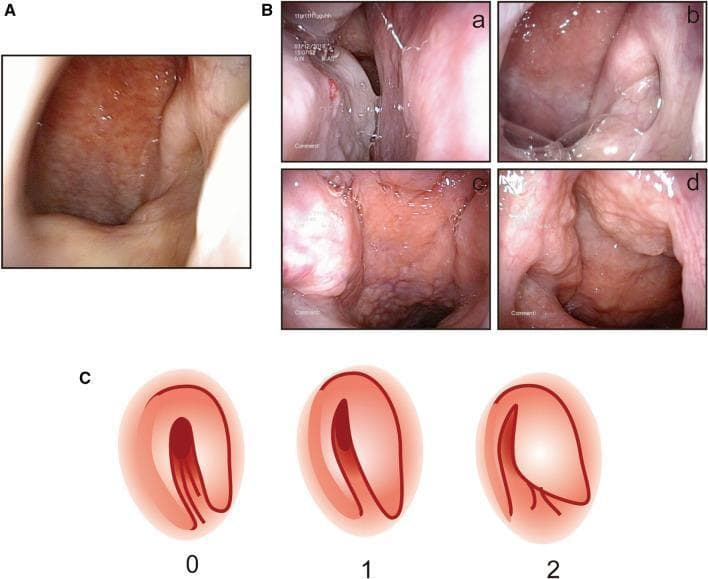 This composite educational image illustrates nasal endoscopic findings and scoring systems used to evaluate allergic rhinitis and Eustachian tube dysfunction. Section A shows a clinical photograph of a normal posterior nostril area with smooth, healthy mucosa. Section B contains four panels (a-d) demonstrating specific pathologies: (a) posterior turbinate swelling, (b) viscous posterior nostril secretions, (c) torus tubarius swelling, and (d) nasopharyngeal lymphatic hyperplasia characterized by a cobblestone mucosal appearance. Section C provides a schematic diagram for scoring the shape of the pharyngeal orifice of the Eustachian tube under a 30° endoscope: Score 0 represents a normal round or oval opening; Score 1 shows a narrow, fissure-like orifice; and Score 2 indicates a completely blocked or non-visualized orifice. This material is designed for Otolaryngology (ENT) training to standardize endoscopic assessment of the nasopharynx and its impact on Eustachian tube patency.