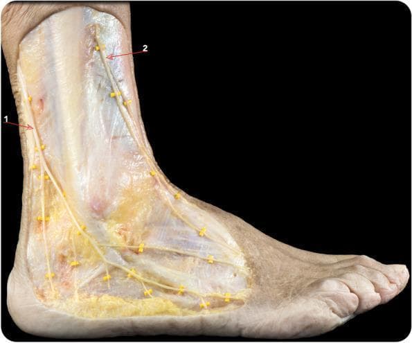 This clinical photograph displays a high-quality anatomical dissection of the lateral and anterolateral aspects of the human distal lower leg, ankle, and foot. The superficial fascia has been removed to expose the neural pathways critical for peripheral nerve blocks. The sural nerve (labeled 1) is shown coursing posterior to the lateral malleolus, demonstrating its characteristic distal arborization into several small branches that provide sensory innervation to the lateral margin of the foot. The superficial peroneal nerve (labeled 2) is visible descending along the anterolateral compartment. It bifurcates into its two primary terminal branches: the medial dorsal cutaneous nerve and the intermediate dorsal cutaneous nerve, which extend toward the dorsum of the foot. The image highlights the superficial nature of these nerves within the subcutaneous tissue, emphasizing their clinical relevance for achieving regional anesthesia through ankle block techniques. Anatomical landmarks such as the lateral malleolus and the extensor tendons are visible under the dissected layers, providing topographical context for nerve localization.