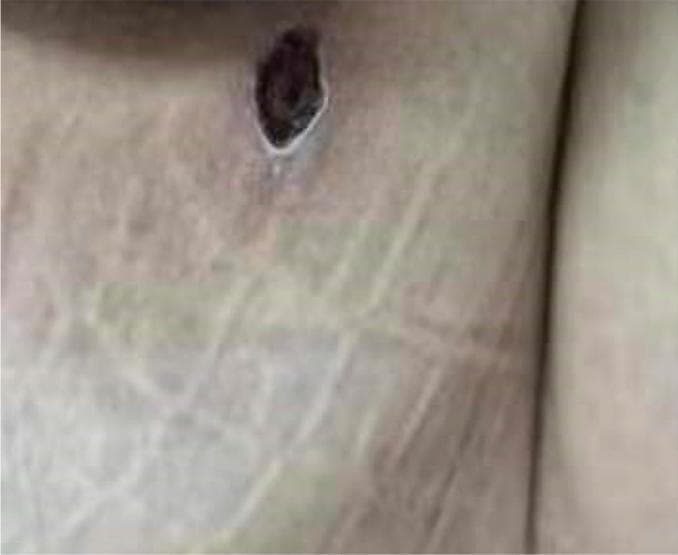 Clinical photograph of a pathognomonic eschar on the left buttock, a hallmark sign of scrub typhus (Orientia tsutsugamushi infection). The lesion is approximately 1 cm in diameter, presenting as a dark brown to black necrotic center (crust) with an oval-to-circular shape and irregular borders. A distinct pale, slightly raised inflammatory halo surrounds the central eschar, creating the characteristic 'cigarette burn' appearance. The surrounding skin exhibits faint erythema and prominent striae distensae (stretch marks). This visual finding is a critical diagnostic indicator in rickettsial diseases, typically representing the site of a larval mite (chigger) bite. Clinically, it aids in differentiating scrub typhus from other febrile illnesses in endemic regions.
