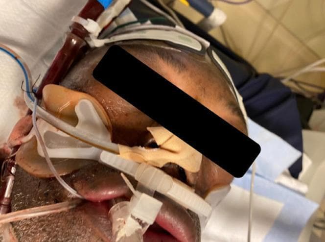 This clinical photograph illustrates a patient presenting with severe facial and neck edema, a classic hallmark of Superior Vena Cava (SVC) Syndrome. The patient exhibits massive swelling (anasarca-like) of the periorbital, cheek, and lip regions, resulting in a significantly turgid and distorted facial appearance. The neck also shows pronounced soft tissue swelling. Several critical care interventions are visible: an endotracheal tube is secured with a commercial holder for respiratory support, and a large-bore percutaneous cannula, likely part of a dual-lumen right ventricular assist device (RVAD), is inserted into the neck. There is visible blood within the proximal tubing of the cervical access. The image demonstrates the dramatic clinical presentation of venous congestion and high central venous pressure (CVP) following iatrogenic SVC obstruction. This visual serves as an educational example of device-related vascular complications in intensive care settings, highlighting the immediate physical manifestations of impaired venous return from the head and upper extremities.