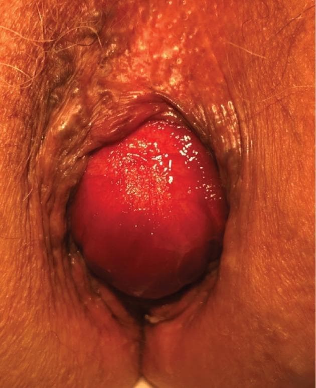 A clinical photograph of the perianal region showing an isolated anterior rectal prolapse in an 84-year-old female. The most prominent feature is a large, globular, erythematous mass protruding through the anal orifice. The prolapsed tissue exhibits a smooth, glistening mucosal surface and is notably lacking the concentric circular folds typically characteristic of full-thickness rectal intussusception. This absence of concentric rings suggests a different underlying mechanism, such as a herniation of an enterocele. The surrounding perianal skin shows signs of atrophy and fine wrinkling consistent with aging. The mass is significant in size, occupying the majority of the visible anal aperture. This image is an educational example for gastroenterology and urogynecology, highlighting the clinical distinction between various types of rectal bulges and the physical signs of anterior rectal wall prolapse secondary to pelvic floor descent or enterocele.