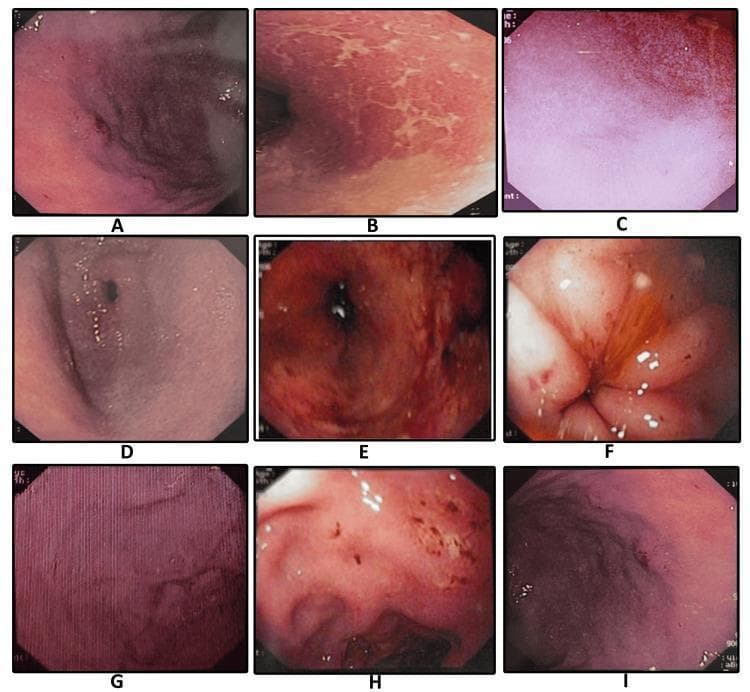 A composite of nine endoscopic images (labeled A-I) illustrating the diverse clinical manifestations of Helicobacter pylori-associated gastritis and peptic ulcer disease within the gastric and duodenal mucosa. The images provide a comparative overview of mucosal pathology: (A) demonstrates mucosal erosion with punctate dark lesions; (B) shows adherent sticky mucus appearing as whitish-yellow patches; (C) illustrates diffuse mucosal erythema; (D) depicts antral gastritis with generalized hyperemia; (E) highlights spotty redness across the mucosal surface; (F) reveals a duodenal ulcer with surrounding inflammatory changes; (G) displays classic nodular gastritis characterized by a uniform, 'cobblestone' or granular mucosal texture; (H) shows a gastric ulcer with evidence of active erosion; and (I) exhibits hypertrophic gastropathy with significantly enlarged rugal folds. This educational compilation is essential for gastroenterology training to differentiate specific morphological patterns such as nodularity, erosions, and fold thickening during diagnostic upper gastrointestinal endoscopy.