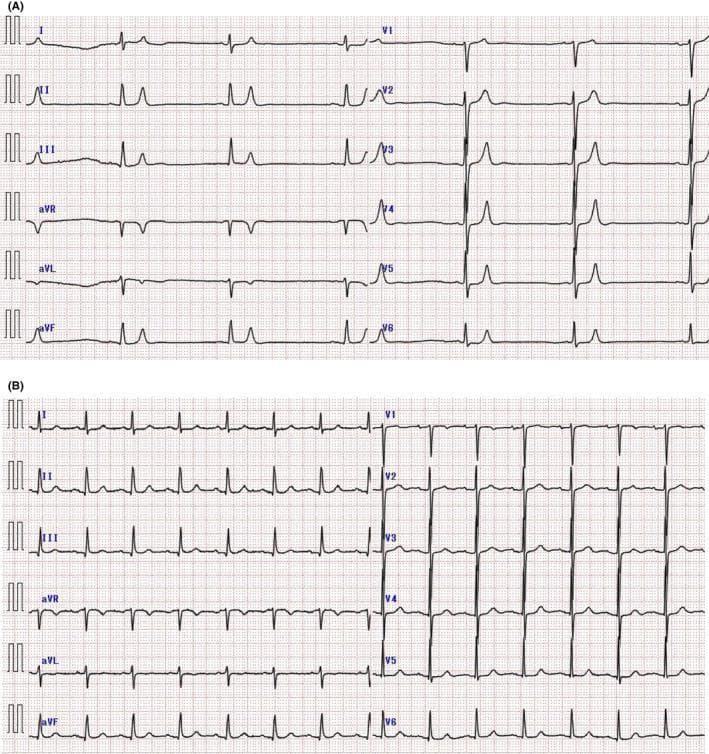 This comparison chart consists of two 12-lead electrocardiograms (ECGs) demonstrating the classic visual progression and resolution of severe hyperkalemia. Panel A shows an ECG from a patient with a serum potassium level of 9.2 mEq/L, characterized by profound bradycardia (37 bpm), diminished P-wave amplitude (atrial standstill precursor), and tall, narrow, 'tented' T-waves most prominent in the precordial leads V1-V6. Panel B displays the follow-up ECG after treatment (serum potassium 4.5 mEq/L), showing a return to normal sinus rhythm with a faster heart rate, clearly defined P-waves, and normalized T-wave morphology. The visual comparison serves as an educational tool for identifying life-threatening electrolyte imbalances, specifically the early to mid-stage ECG manifestations of hyperkalemia. Key clinical markers highlighted include T-wave tenting and the impact of hyperkalemia on cardiac conduction and rhythm stability.