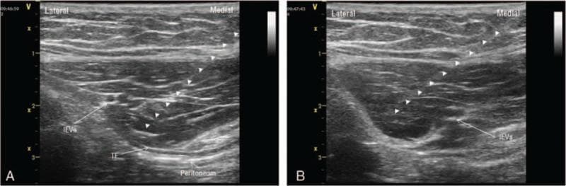 This diagnostic ultrasound display contains two frames (A and B) demonstrating an ultrasound-guided rectus sheath block (RSB). The images show the cross-sectional anatomy of the abdominal wall, specifically focusing on the posterior rectus sheath region. Key anatomical landmarks identified include the inferior epigastric vessels (IEVs), which appear as hypoechoic circular structures, the transversalis fascia (TF) visualized as a thin hyperechoic line, and the underlying peritoneum. Small white arrowheads indicate the needle trajectory using an in-plane technique. Frame A illustrates the needle tip positioned in the fascial plane between the medial aspect of the IEVs and the TF. Frame B shows the needle repositioned to the lateral aspect of the IEVs, with an evident hypoechoic fluid collection representing local anesthetic injectate separating the IEVs from the transversalis fascia. This image serves as a clinical guide for regional anesthesia, highlighting the precise needle placement required to achieve an effective superficial rectus sheath block while avoiding vascular or peritoneal injury.