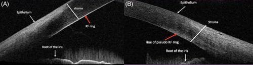 This diagnostic image consists of two panels (A and B) featuring Anterior Segment Optical Coherence Tomography (AS-OCT) cross-sections of the peripheral cornea and anterior chamber angle. The image compares the appearance of corneal deposits in different clinical conditions. Panel A illustrates a classic Kayser-Fleischer (KF) ring, characteristic of Wilson disease, visualized as a discrete hyperintense line located specifically on the Descemet membrane at the posterior corneal surface. In contrast, Panel B demonstrates a 'pseudo-KF ring,' often associated with non-Wilsonian hyperbilirubinemia, which appears as a diffuse, scattered hyper-reflective hue localized within the posterior stroma rather than a distinct line on the Descemet membrane. Both panels are labeled with key anatomical structures including the epithelium, stroma, and the root of the iris. This comparison serves as an educational tool for ophthalmologists and hepatologists to differentiate between true copper deposits and pigmentary changes due to bile pigments using high-resolution imaging.