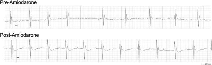 A comparison of two electrocardiogram (ECG) rhythm strips demonstrating pharmacological cardioversion in a murine model. The top strip, labeled 'Pre-Amiodarone,' shows atrial fibrillation (AF) characterized by an irregularly irregular ventricular rhythm, varying R-R intervals, and the absence of distinct P waves. The baseline exhibits fibrillatory activity (f-waves). The bottom strip, labeled 'Post-Amiodarone,' displays a return to sinus rhythm following the administration of the Class III anti-arrhythmic agent. Key features of the post-treatment trace include a regular rhythm with consistent R-R intervals, clearly visible P waves preceding each QRS complex, and well-defined T waves. The ECG grids include a 20 msec scale bar for temporal reference. This visual comparison illustrates the efficacy of amiodarone in converting a tachydysrhythmia back to normal sinus rhythm, serving as a representative example of pharmacological intervention for atrial arrhythmias in translational cardiology research.