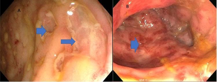 This composite diagnostic image features two endoscopic panels demonstrating manifestations of Crohn’s disease within the gastrointestinal tract. Panel A shows a colonoscopic view of the colonic mucosa, highlighting characteristic 'skip lesions.' Blue arrows indicate deep, linear ulcerative lesions interspersed with areas of relatively spared, normal-appearing mucosa, creating a discontinuous pattern of inflammation. Panel B presents an esophagogastroduodenoscopy (EGD) view of the gastric mucosa. This panel demonstrates significant erythema and a classic 'cobblestone' appearance, where longitudinal and transverse ulcerations separate islands of edematous, inflamed mucosa (noted by the blue arrow). These findings are hallmark endoscopic features of transmural inflammatory bowel disease (IBD), specifically Crohn's disease, showing multi-segmental involvement and mucosal architectural distortion. The image serves as an educational reference for identifying active Crohn's disease during lower and upper endoscopy.