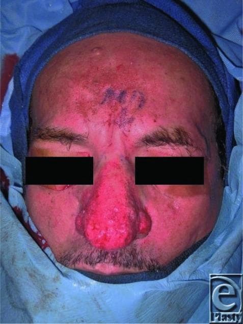 This clinical photograph shows the face of a patient in a perioperative setting, demonstrating advanced rhinophyma, the end-stage clinical manifestation of acne rosacea. The nose is severely enlarged with a bulbous, irregular, and lobulated morphology that has obliterated the normal anatomical subunits. The nasal skin exhibits intense erythema, prominent pitting, and sebaceous gland hyperplasia. Diffuse facial erythema is also visible across the forehead and cheeks, consistent with underlying rosacea. Surgical markings are present on the central forehead. The image illustrates the classic visual features used to diagnose rhinophyma clinically and serves as a teaching tool for identifying dermal fibrosis and telangiectasias in dermatological and plastic surgery contexts. The primary educational focus is on the progressive tissue hypertrophy and skin surface irregularities associated with chronic inflammatory skin conditions of the face.