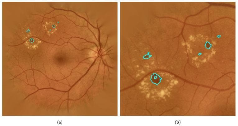 This diagnostic image displays a color fundus photograph of a human retina, highlighting clinical manifestations of diabetic retinopathy. The image is presented in two panels: (a) a wide-field view of the posterior pole and (b) a magnified view focusing on specific retinal lesions (RLs). Visible anatomical landmarks include the optic disc on the right, the macula centrally, and the branching retinal vasculature. Pathological findings consist of multiple bright, yellowish-white hard exudates clustered in the macula and paramacular regions. These exudates appear as granular or homogeneous deposits with varied morphologies. Interspersed among these are dark red, punctate microaneurysms and small hemorrhages. Cyan-colored digital contours outline definitively detected lesions, demonstrating an automated segmentation approach for diabetic lesion classification. The image serves as an educational tool for ophthalmology, specifically for identifying and segmenting vascular complications and lipid deposits associated with chronic retinal disease. The clinical focus is on the detection and differentiation of microaneurysms and exudates within a non-proliferative diabetic retinopathy context.