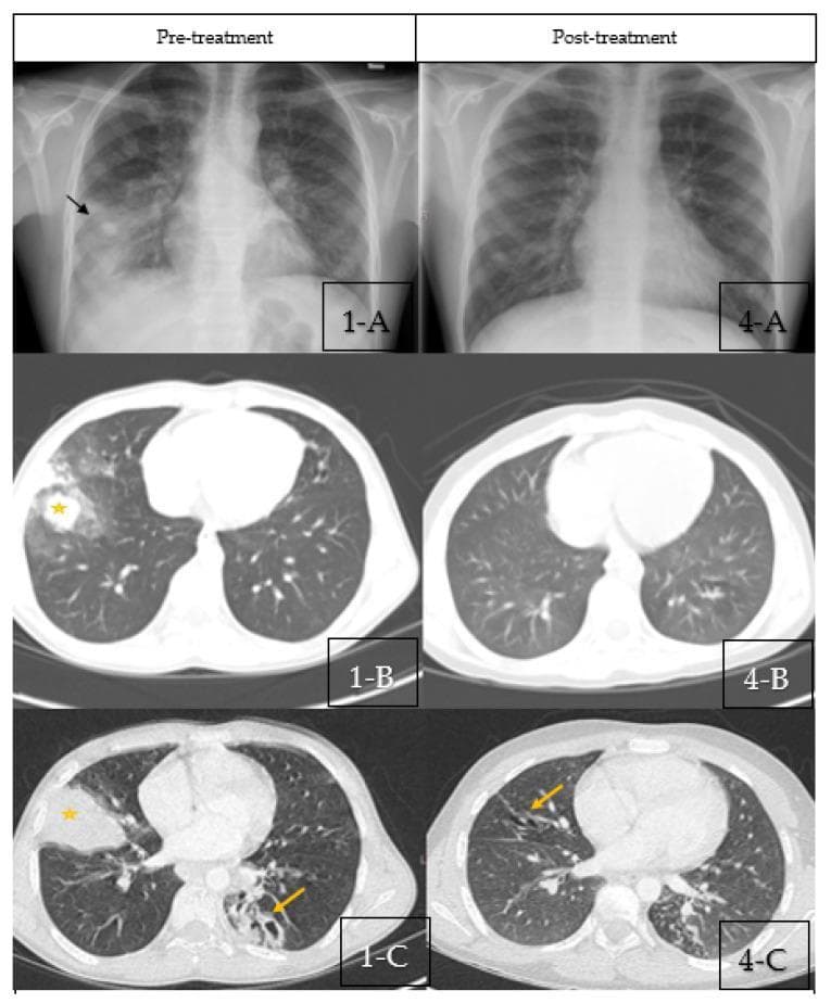 This composite diagnostic image compares pre-treatment and post-treatment thoracic imaging in a patient with allergic bronchopulmonary aspergillosis (ABPA). Pre-treatment imaging (1-A, 1-B, 1-C) includes a posterior-anterior chest X-ray showing right middle lobe consolidation (black arrow) and scattered bilateral nodular opacities. Corresponding axial CT scans demonstrate bilateral central bronchiectasis, characteristic 'finger-in-glove' mucus impaction (yellow arrow), and areas of segmental/subsegmental atelectasis (yellow star). Post-treatment imaging (4-A, 4-B, 4-C) after steroid therapy reveals significant interval improvement. The chest X-ray (4-A) shows complete resolution of the right middle lobe consolidation. The follow-up axial CT scans (4-B, 4-C) demonstrate the clearance of mucus impaction and resolution of atelectasis, though residual cylindrical central bronchiectasis (yellow arrows) remains visible. This comparison illustrates the typical radiological progression and therapeutic response of mucoid impaction and secondary lung collapse in inflammatory airway disease.