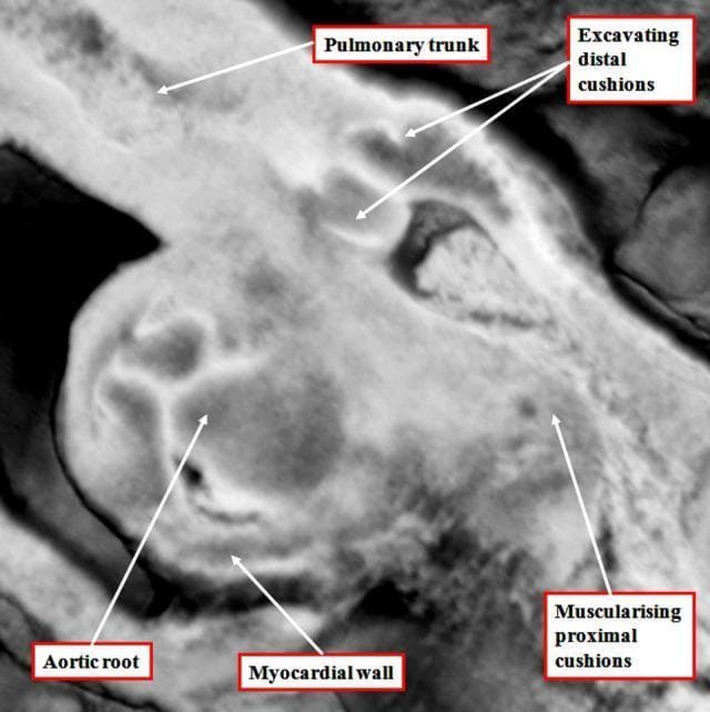 A high-magnification diagnostic image in grayscale showing the embryological development of the human cardiac outflow tract. The image identifies the early morphological stages of arterial valve formation within the intermediate component of the outflow tract. Key labeled structures include the pulmonary trunk and aortic root, illustrating the ongoing septation process. A significant educational feature is the 'excavating distal cushions,' which represent the primordial leaflets of the arterial valves undergoing tissue remodeling. The 'myocardial wall' is clearly visible, forming a myocardial turret that still encases the intermediate outflow tract at this stage. Additionally, the 'muscularising proximal cushions' are highlighted, demonstrating the transition of the cardiac jelly into muscular tissue that will eventually contribute to the ventricular infundibulum. This visual content serves as an educational tool for embryology and pediatric cardiology, focusing on the second heart field's contribution to heart development and the complex transition from simple cushions to structured semilunar valves.