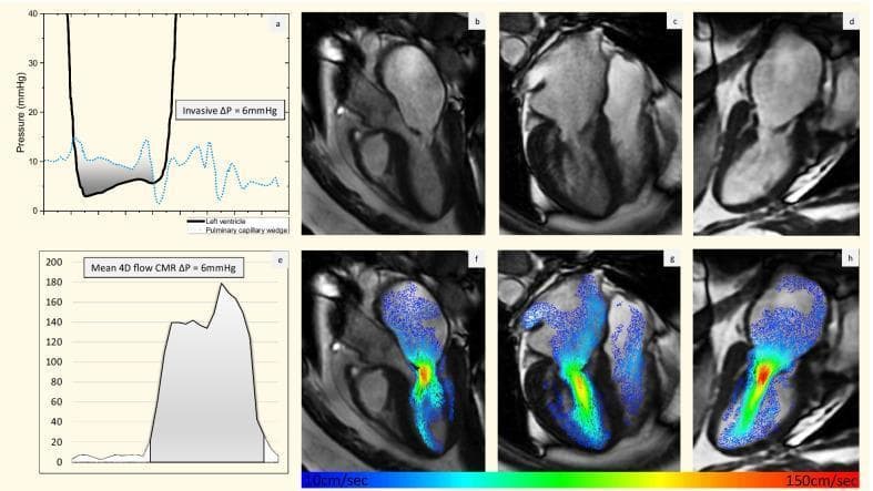 This composite figure illustrates the multimodal assessment of moderate mitral stenosis using invasive hemodynamics and 4D Flow Cardiovascular Magnetic Resonance (CMR). Panel (a) shows an invasive pressure tracing comparing pulmonary artery wedge pressure (PAWP) and left ventricular pressure (LVP), demonstrating a mean diastolic gradient of 6 mmHg. Panels (b-d) display anatomical CMR images in the left ventricular outflow tract (LVOT), 4-chamber, and vertical long axis views, revealing morphological hallmarks of mitral stenosis: thickened mitral valve leaflets, restricted leaflet opening (doming), and secondary left atrial dilatation. Panels (f-h) provide 4D flow velocity overlays (color-coded from 0 cm/sec in blue to 150 cm/sec in red) superimposed on the anatomical views. These overlays demonstrate high-velocity flow jets (red/orange) accelerating through the stenotic mitral orifice during diastole. Panel (e) shows the corresponding quantification of peak velocity derived from the 4D flow data, aligning with the invasive mean pressure drop. The figure serves as an educational comparison between gold-standard invasive manometry and non-invasive advanced cardiac imaging for valvular heart disease evaluation.