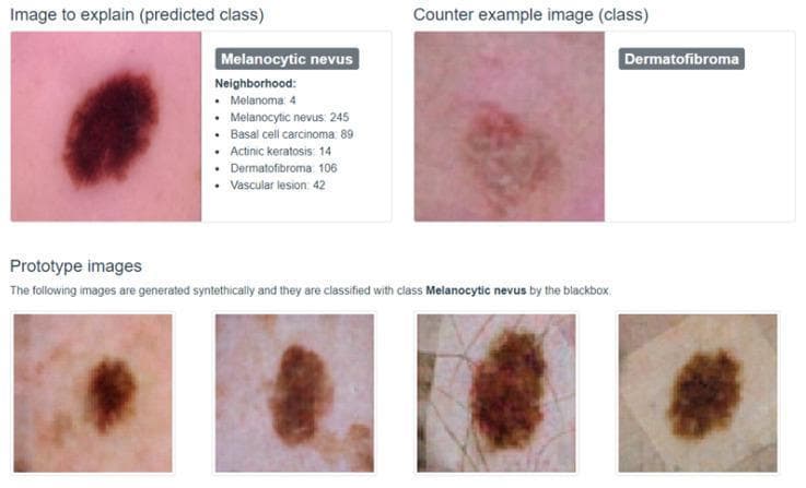 This clinical dermatological comparison chart showcases visual differentiation between types of skin lesions as used in machine learning classification models. The upper section features a 'Clinical Photograph' of a melanocytic nevus (the primary case), appearing as a dark brown, well-circumscribed, oval macule with uniform pigmentation and smooth texture. It is positioned adjacent to a 'Counter example image' of a dermatofibroma, which displays a lighter, reddish-brown hue, less distinct borders, and a subtle central firm or dimpled texture characteristic of this benign fibrous tumor. The lower section presents four 'Prototype images' (exemplars) of melanocytic nevi, demonstrating natural variability in lesion morphology. These variations include differences in color intensity (ranging from tan to deep brown), border regularity, and the visibility of surrounding skin markings such as fine lines and hair follicles. This visual tool is designed for medical education and AI model interpretability, helping to distinguish between benign melanocytic proliferations and non-melanocytic skin lesions like dermatofibromas based on morphology, color distribution, and border characteristics.