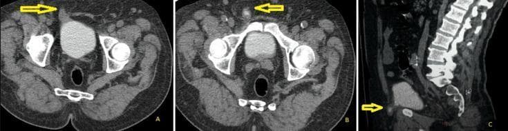 This composite diagnostic image features three panels (A, B, and C) of an abdomino-pelvic computerized tomography (CT) scan. Panels A and B are axial views, and Panel C is a sagittal view. The imaging demonstrates a right direct inguinal hernia involving the urinary bladder. In axial view A, a yellow arrow points to a lateral protrusion of the contrast-filled urinary bladder wall into the inguinal canal, identified as a bladder horn or cystocele. View B, at a lower axial level, shows the continuation of the herniated tissue near the symphysis pubis. The sagittal view (C) provides a longitudinal perspective, with a yellow arrow highlighting the bladder anteriorly herniating through the abdominal wall defect. The images show key pelvic anatomy including the sacrum, iliac bones, pelvic floor musculature, and the lumbar-sacral spine. This case illustrates a rare content of a direct inguinal hernia, useful for surgical planning and differentiating between direct and indirect hernia types based on their relationship to the inferior epigastric vessels.