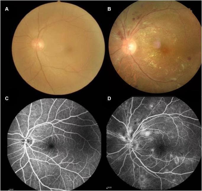 Comparison of color fundus photography and fluorescein fundus angiography (FFA) between healthy individuals and patients with hypertensive retinopathy (HR). Panels A and B are color fundus photographs; Panel A displays a healthy retina with clear vessel margins and an even fundus appearance, while Panel B demonstrates severe hypertensive retinopathy features including retinal hemorrhages, hard exudates (yellowish deposits), cotton-wool spots, and retinal edema. Panel B also shows vascular signs of arteriosclerosis such as arteriolar narrowing (stenosis), increased vessel wall light reflex, and arteriovenous (A/V) crossing changes. Panels C and D provide the corresponding FFA images. Panel C illustrates normal, uniform vascular filling and intact blood-retinal barriers. Panel D shows pathologic findings in a patient with HR, characterized by irregular vascular filling, diffuse fluorescein leakage indicative of compromised vessel integrity, and areas of capillary non-perfusion. This clinical comparison highlights the diagnostic landmarks used by ophthalmologists to grade the severity of hypertensive microvascular damage.