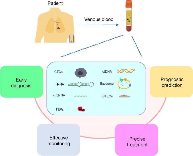 This medical infographic illustrates the clinical application of liquid biopsy in the management of lung cancer. The diagram depicts a patient with a primary lung tumor undergoing venous blood collection. The blood sample, shown in a collection tube, is analyzed for various circulating biomarkers. A central inset highlights seven key liquid biopsy components: circulating tumor cells (CTCs) as irregular dark cells; circulating tumor DNA (ctDNA) shown as double-helix strands; exosomes as membrane-bound vesicles; microRNAs (miRNA); circular RNAs (circRNA); tumor-educated platelets (TEPs); and circulating tumor vascular endothelial cells (CTECs). Four peripheral boxes describe the clinical utility of analyzing these biomarkers: early diagnosis, prognostic prediction, effective monitoring of disease progression, and precise treatment selection. This illustration serves as a summary of non-invasive diagnostic pathways, highlighting the role of liquid biopsy in capturing tumor heterogeneity and providing real-time clinical data for oncology.