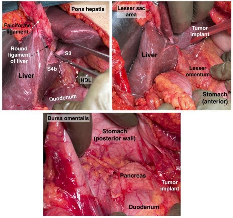 A series of three annotated clinical photographs showing surgical views of the upper abdomen during a cytoreductive procedure, specifically focusing on the anatomy of the liver, lesser sac, and bursa omentalis.
Image 1 (Top Left): Demonstrates the liver with segments S3 and S4b clearly visible. Key landmarks include the 'pons hepatis' (an anatomical liver bridge), the falciform ligament, and the round ligament of the liver. The hepatoduodenal ligament (HDL) is highlighted adjacent to the duodenum.
Image 2 (Top Right): Focuses on the lesser sac area, showing the relationship between the liver and the lesser omentum. A metastatic tumor implant is indicated on the lesser omentum near the anterior wall of the stomach.
Image 3 (Bottom): Provides a view of the bursa omentalis after retraction. Anatomical structures shown include the posterior wall of the stomach, the pancreas, and the duodenum. A tumor implant is highlighted in the vicinity of the pancreas and duodenum, demonstrating typical peritoneal dissemination patterns.
These images serve as educational material for identifying potential sites of neglected tumor implants in advanced epithelial ovarian cancer (AEOC) surgery.