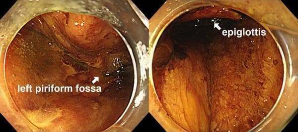 This diagnostic endoscopic clinical photograph captures two views of the laryngopharynx following an accidental reflux of Lugol's iodine solution during an endoscopic submucosal dissection (ESD) procedure. The mucosa of the pharyngeal region, including the epiglottis and the left piriform fossa, is prominently stained with a dark brown, mahogany-colored solution, which contrast significantly with the normal pale pink appearance of healthy pharyngeal tissue. On the left side of the composite image, the left piriform fossa is labeled, showing the deep recess of the laryngopharynx. The right side of the image highlights the superior portion of the epiglottis. The visualization demonstrates the extent of iodine dispersion across the laryngeal inlet and surrounding structures. This image is clinically significant for illustrating potential complications of chromoendoscopy, specifically the inadvertent exposure of sensitive laryngeal mucosa to caustic staining agents like Lugol's solution, which can lead to chemical-induced laryngitis and subsequent edema or erosion.