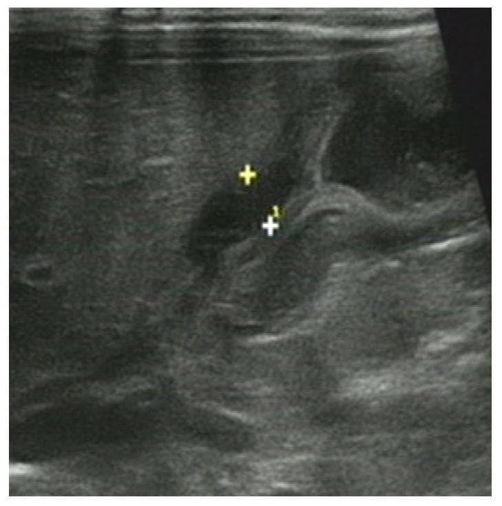 This abdominal ultrasound image depicts a case of Hypertrophic Pyloric Stenosis (HPS) in a 22-day-old male infant. The diagnostic image shows a longitudinal view of the pyloric canal, characterized by marked thickening of the pyloric muscularis layer. Electronic calipers, labeled '+' and '+1', are positioned to measure the muscle wall thickness (single-wall thickness), demonstrating a hypoechoic and homogenous muscular rim. The central pyloric mucosa appears compressed and echogenic, creating the typical 'olive' or 'doughnut' sign in cross-section (not shown) or an elongated canal in this longitudinal plane. Key clinical indices for diagnosis include a muscle thickness exceeding 3-4 mm and an overall pyloric canal length greater than 15-17 mm. This visual evidence is a classic hallmark of neonatal gastric outlet obstruction requiring surgical intervention.