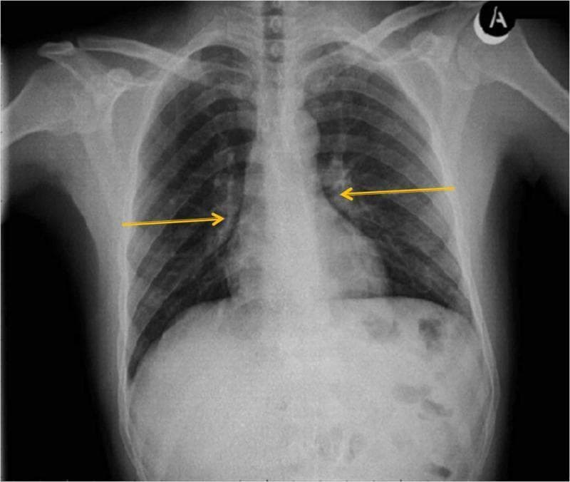 This diagnostic image is a posterior-anterior (PA) chest X-ray illustrating the skeletal thorax and pulmonary structures. The radiograph displays the bilateral clavicles, ribs, and thoracic vertebrae, which appear intact. The lung fields are largely radiolucent and symmetrical in volume. The cardiac silhouette is centrally located in the mediastinum with a normal transverse diameter. Two yellow arrows point specifically to the bilateral hila, indicating pulmonary portal dilatation. This finding is characterized by an abnormal widening and increased radiopacity of the pulmonary vascular structures at the root of both lungs. The costophrenic angles appear sharp, and no significant pleural effusion or consolidation is immediately evident. This clinical imaging is relevant for students and practitioners learning to identify vascular abnormalities in the pulmonary hilum and for distinguishing normal cardiothoracic anatomy from signs of pulmonary hypertension or congestion.