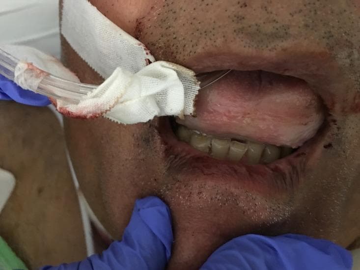 This clinical photograph displays a close-up view of a patient's oral cavity exhibiting severe macroglossia (tongue swelling). The tongue is markedly enlarged and edematous, occupying nearly the entire visible oropharyngeal space and obscuring the soft palate and uvula. This presentation is consistent with a Mallampati Class IV airway, indicating a high risk for airway obstruction. The tongue surface appears relatively smooth with focal areas of pallor and erythema. A clear medical tube, likely an endotracheal or orogastric tube, is positioned at the corner of the mouth, secured with white gauze that shows minor serosanguinous staining. The surrounding perioral region and lips also show signs of swelling. This image serves as a critical educational example of acute angioedema, frequently associated with ACE inhibitor use (such as lisinopril), highlighting the importance of emergent airway management in clinical practice.