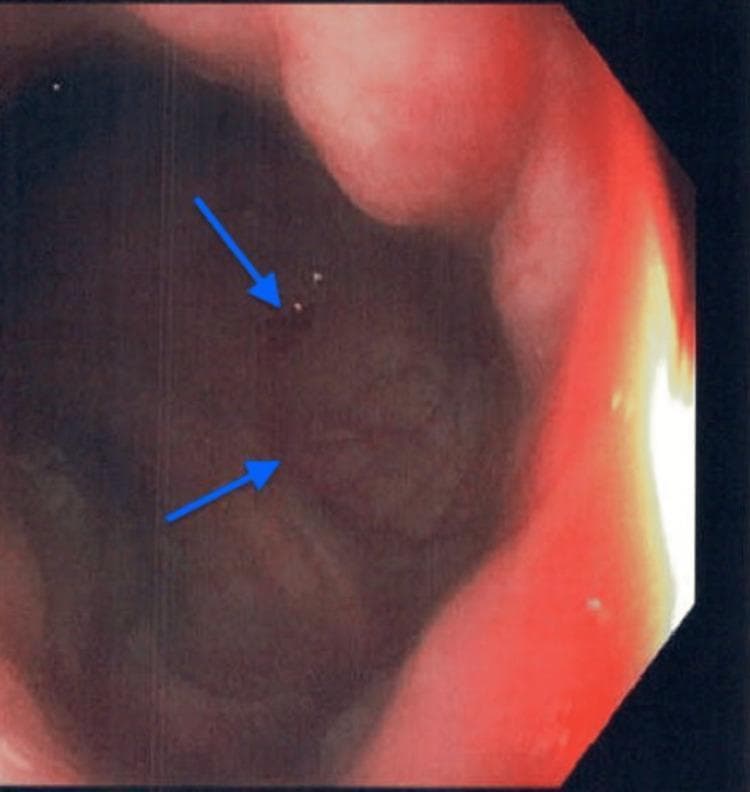 This diagnostic endoscopic image captures the terminal ileum during a colonoscopy, demonstrating active terminal ileitis. The visual field shows a dark red, erythematous mucosal lining with significant congestion. Key pathological features include uneven mucosal texture and patchy distribution of surface ulcerations, indicated by blue arrows pointing to disruptions in the tissue and small bright spots of reflecting light. The image illustrates signs of acute inflammation within the distal small bowel, a hallmark finding in conditions such as Crohn's disease or drug-induced enteropathy. The surrounding luminal walls appear thickened and edematous, while the loss of the typical vascular pattern suggests underlying mucosal damage and inflammation. This educational visual serves as a representative example of inflammatory bowel disease (IBD) manifestations during lower gastrointestinal endoscopy.