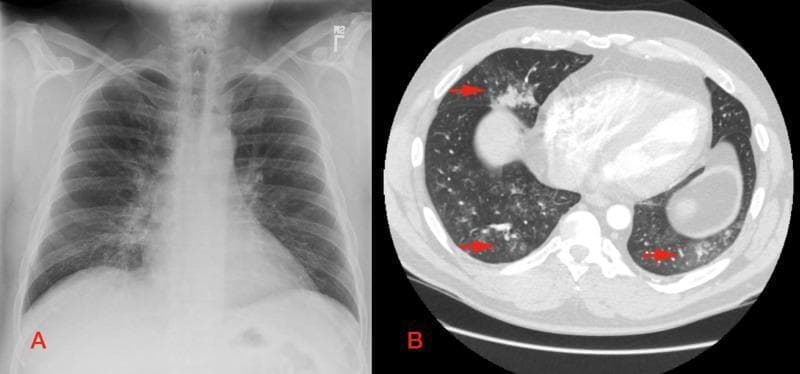 This composite figure consists of two diagnostic images of the human chest, labeled A and B, illustrating the radiographic presentation of hypersensitivity pneumonitis. Image A is a posteroanterior (PA) chest X-ray showing a focal opacity in the right middle lobe, suggestive of an infiltrate. Image B is an axial section of a CT pulmonary angiogram (CTPA) at the level of the lower heart. The CT scan reveals more extensive pathology than the X-ray, demonstrating diffuse bilateral ground-glass opacities (GGO) and numerous centrilobular nodular opacities, several of which are highlighted by red arrows. Patchy areas of consolidation are also visible, specifically involving the right middle lobe and posterior segments of the bilateral lower lobes. This comparison highlights the superior sensitivity of CT over plain film radiography in characterizing the morphology and multi-lobar distribution of interstitial lung diseases and inflammatory pneumonitis.