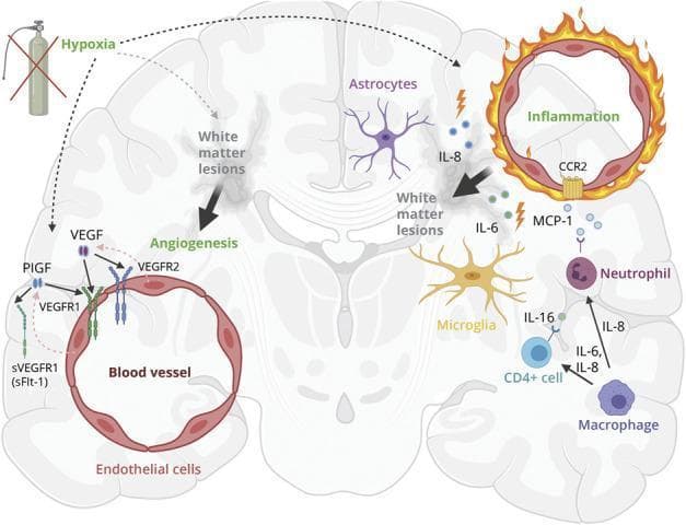 This pathophysiology diagram illustrates the theoretical relationship between hypoxia, neuroinflammation, and pathologic angiogenesis in the development of white matter lesions (WML) in the human brain. The model identifies hypoxia as a primary driver, initiating two parallel cascades. On the left, hypoxia induces an angiogenic response: Placental Growth Factor (PlGF) and Vascular Endothelial Growth Factor (VEGF) are upregulated. PlGF binds to VEGFR1, while VEGF binds to both VEGFR1 and VEGFR2 on endothelial cells. The soluble receptor sVEGFR1 (sFlt-1) acts as an inhibitor by sequestering these growth factors. On the right, hypoxia triggers a neuroinflammatory cascade involving astrocytes and microglia, which release proinflammatory markers IL-8, IL-6, IL-16, and MCP-1. These cytokines facilitate the recruitment of immune cells, including neutrophils, CD4+ T-cells, and macrophages, leading to chronic inflammation and blood-brain barrier (BBB) disruption. The convergence of pathologic angiogenesis and neuroinflammation contributes to the formation and progression of white matter lesions within the brain parenchyma.