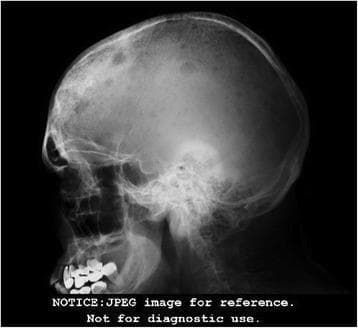 This lateral skull radiograph (X-ray) demonstrates the classic 'punched-out' or 'moth-eaten' appearance characteristic of multiple myeloma. The image reveals numerous well-circumscribed, round-to-oval radiolucent (lytic) lesions of varying sizes distributed across the calvarium, including the frontal, parietal, and occipital bones. These lesions show no evidence of peripheral sclerotic margins, indicating aggressive bone resorption without significant reactive bone formation. The calvarial diploe is notably involved, showing a generalized decrease in bone density and disruption of the normal trabecular pattern. Clinical significance of these findings includes the hallmark skeletal manifestations of plasma cell dyscrasias, where monoclonal plasma cells infiltrate the bone marrow, triggering osteoclast activity. This diagnostic image serves as an educational example of hematologic malignancy-associated osteolysis and is a critical component of a skeletal survey for staging conditions like multiple myeloma or metastatic disease.