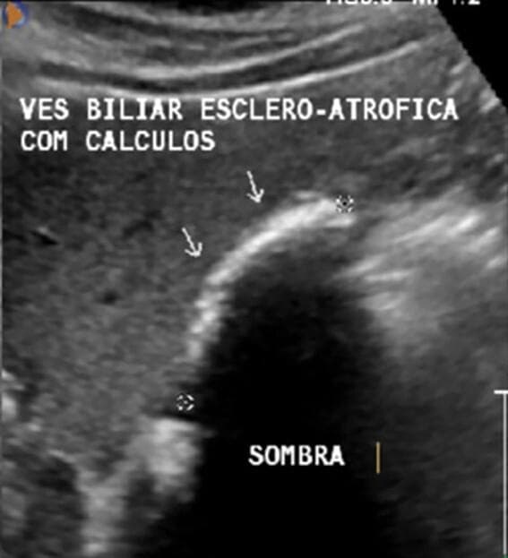This diagnostic image is an abdominal ultrasound in the right upper quadrant demonstrating a scleroatrophic gallbladder. The primary visual finding is a shrunken, contracted gallbladder lumen that is largely replaced by echogenic material. Hyperechoic (bright) structures, indicated by white arrows, represent multiple gallstones (cholelithiasis) densely packed within the organ. A prominent posterior acoustic shadow, labeled as 'SOMBRA', is visible distal to the calculi, a hallmark sonographic sign of gallstones. The image illustrates chronic cholecystitis leading to a 'Wall-Echo-Shadow' (WES) sign or scleroatrophic appearance, where the gallbladder wall and the echo from the stones are closely apposed. This finding is of high clinical significance in hepatobiliary imaging as it confirms cholelithiasis in a chronically diseased, contracted gallbladder, which can complicate surgical interventions such as cholecystectomy.