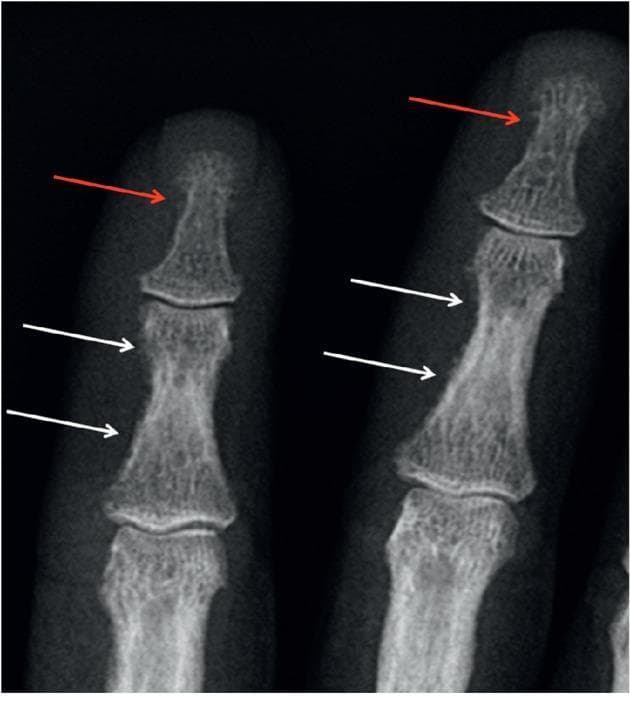 This diagnostic image is a close-up radiograph (X-ray) of the second and third fingers, demonstrating classic skeletal manifestations of hyperparathyroidism. Key pathological features are identified with anatomical precision. Subperiosteal resorption is prominently visible along the radial aspects of the middle phalanges (indicated by white arrows), characterized by a thinned, feathery, and irregular lace-like cortical margin. Additionally, the distal phalangeal tufts show signs of acroosteolysis (indicated by red arrows), where the normally smooth bone appears blunted, frayed, and resorbed. These osseous changes are pathognomonic findings often associated with primary hyperparathyroidism or renal osteodystrophy. The image serves as an educational tool for identifying metabolic bone disease, highlighting the importance of hand radiographs in detecting early osteoclastic activity and cortical bone destruction.