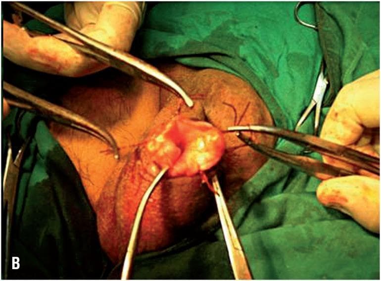 This clinical photograph captures an intraoperative view of a surgical procedure on the male scrotum, specifically a minimally invasive hydrocelectomy using the eversion technique (Lord's or Jaboulay-type modification). The surgical field shows the scrotum stabilized with surgical clamps and forceps. A small incision has been made, through which the parietal tunica vaginalis is everted. The image demonstrates the critical step of suturing the edge of the tunica vaginalis directly to the dartos fascia and scrotal skin. This maneuver aims to keep the visceral surface of the tunica vaginalis exposed to the lymph-rich subcutaneous tissues to facilitate fluid absorption and prevent hydrocele recurrence. Visible elements include surgical instrumentation (hemostats and forceps), interrupted suture lines securing the everted tissue, and the characteristic red, vascularized appearance of the visceral tunica. This content is intended for urological surgical training, illustrating anatomical landmarks and technical execution of scrotal sac eversion.