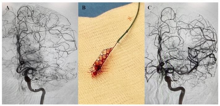 Educational panel illustrating endovascular management of an acute ischemic stroke. Panel A is a cerebral angiogram (digital subtraction angiography) demonstrating an acute occlusion of the left middle cerebral artery (MCA) at the M1 segment, evidenced by a sudden cutoff of contrast filling. Panel B is a clinical photograph of a mechanical thrombectomy specimen, showing a Solitaire stent retriever containing an entrapped red thrombus (clot) on a sterile field. Panel C is a post-thrombectomy cerebral angiogram showing successful TICI 3 recanalization, with restored contrast opacification throughout the distal MCA territory and its cortical branches. The composite demonstrates the sequence of diagnostic imaging, therapeutic intervention (mechanical thrombectomy), and clinical outcome in large vessel occlusion (LVO) stroke. This visual is relevant for neurology and neurointerventional radiology specialties for teaching vascular anatomy and stroke intervention protocols.
