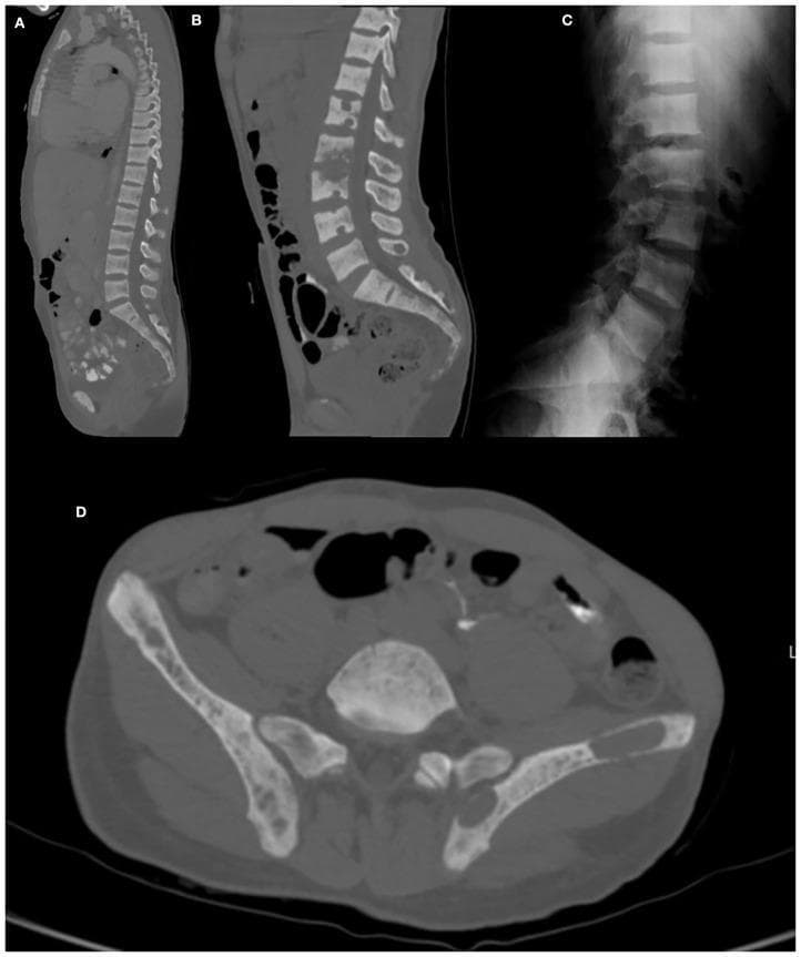 This composite of diagnostic images illustrates musculoskeletal manifestations of renal osteodystrophy and hyperparathyroidism. Images A and B are CT sagittal reconstructions of the thoracic and lumbar spine, demonstrating diffuse osteosclerosis and multiple areas of subperiosteal resorption, reflecting abnormal bone turnover. Image C is a lateral lumbar spine radiograph showing the classic 'rugger jersey spine' sign, characterized by dense sclerotic bands at the superior and inferior vertebral endplates with a more lucent central region, creating a striped horizontal appearance. Image D is an axial CT scan of the pelvis revealing a large, well-defined, expansive 'brown tumor' (osteoclastoma) within the left iliac bone. This lesion appears as a heterogeneous, cystic-like mass that disrupts normal cortical architecture. Collectively, these images provide a comprehensive visual overview of secondary hyperparathyroidism's impact on bone density, including generalized sclerosis, focal resorptive tumors, and characteristic vertebral mineralization patterns.