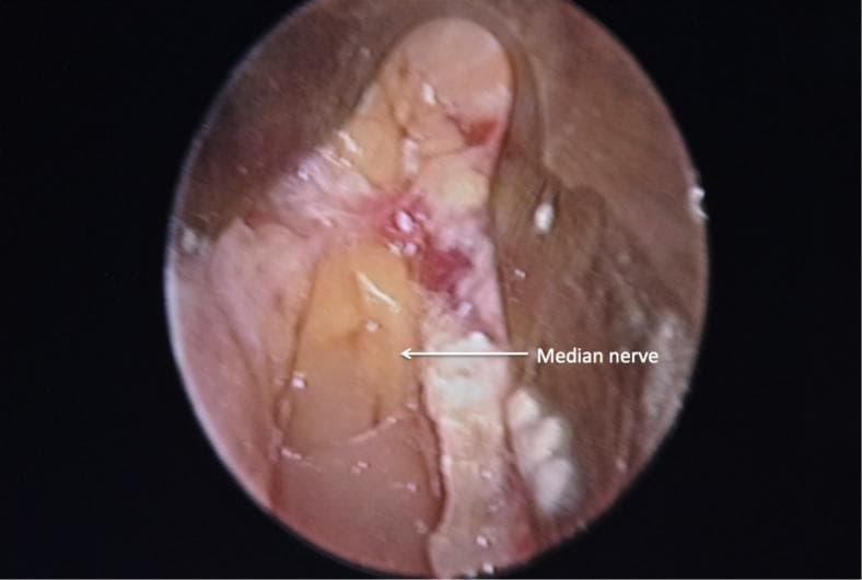This endoscopic clinical photograph provides an intraoperative view of a carpal tunnel release procedure. The image depicts the surgical field after the successful division of the flexor retinaculum (transverse carpal ligament). Centrally located is the median nerve, which appears as a light yellow, elongated structure with a smooth surface texture. A prominent, brighter yellowish-white fat pad is visible overlying the distal portion of the nerve, serving as a critical anatomical landmark for confirming complete ligamentous release. The surrounding surgical field shows reddish-pink soft tissue and muscular layers, indicating local vascularity. The image demonstrates the specialized supraretinacular endoscopic approach, allowing for direct visualization and decompression of the median nerve within the carpal tunnel while minimizing trauma to superficial structures. This visual is intended for orthopedic and neurosurgical education regarding the anatomy of the wrist and endoscopic surgical techniques for carpal tunnel syndrome.