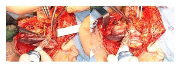 This clinical photograph shows an intraoperative view of a neck dissection (levels II-III) performed on a human patient. The surgical field focuses on the plane of the internal jugular vein (IJV), which is clearly visible as a large, dark-purple vascular structure. The procedure demonstrates the use of a Focus Ultracision harmonic scalpel (HS) for tissue dissection and hemostasis. Key anatomical features include the internal jugular vein and its associated tributary vessels, which are shown being sealed and divided using the ultrasonic device. The harmonic scalpel's curved paddle blade is positioned near the vascular structures, illustrating coaptive coagulation. Surgical instruments in the field include the harmonic scalpel, multiple fine surgical forceps used for tissue retraction and exposure, and a metal retractor maintaining the surgical window. Visible yellow nerve structures are being carefully isolated using clamps to avoid injury. The image serves as an educational resource for head and neck surgery, specifically illustrating the application of ultrasonic energy for vessel sealing and precise dissection along critical vascular planes during oncological or diagnostic neck procedures.