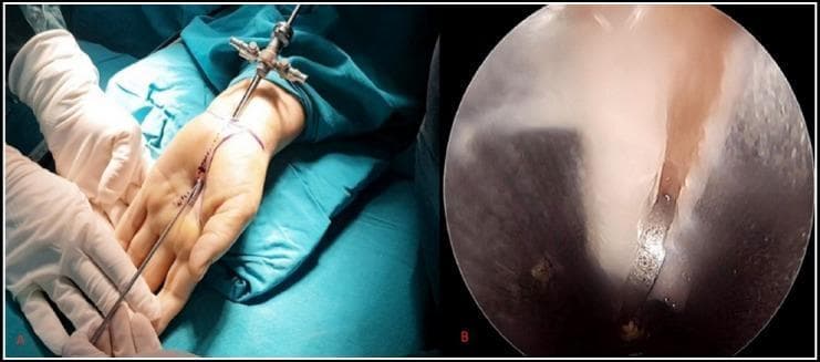 This composite clinical and diagnostic image illustrates Endoscopic Carpal Tunnel Release (ECTR) for the treatment of carpal tunnel syndrome. Image A is a clinical photograph showing the surgical setup: a patient's hand is positioned supine on a sterile blue drape with surgical markings indicating Kaplan's cardinal line. A small proximal wrist incision is visible, through which an endoscopic cannula and obturator assembly are inserted into the carpal canal. A surgeon's gloved hands are shown stabilizing the instrument. Image B provides the corresponding intraoperative endoscopic view from a 4-mm rigid scope. It depicts the pale, fibrous internal surface of the transverse carpal ligament (TCL) with a clear longitudinal division or cut, demonstrating the release of the ligament to decompress the median nerve. This content is intended for orthopedic and neurosurgical education, highlighting the minimally invasive endoscopic approach versus open carpal tunnel release.