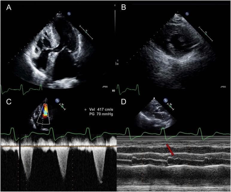 Transthoracic echocardiogram panel demonstrating diagnostic features of hypertrophic cardiomyopathy (HCM). Panel A (apical four-chamber view) and Panel B (parasternal short-axis view) illustrate asymmetric septal hypertrophy, with the interventricular septum measuring 19 mm compared to a 13 mm posterior wall. Panel C shows continuous-wave Doppler across the left ventricular outflow tract (LVOT), revealing a late-peaking systolic jet with a peak velocity of 417 cm/s and a significant pressure gradient (PG) of 70 mmHg, indicative of dynamic obstruction. Panel D presents an M-mode echocardiogram through the aortic valve; the red arrow highlights mid-systolic closure of the aortic valve leaflets, a classic sign of severe LVOT obstruction. The composite images effectively demonstrate the structural and hemodynamic hallmarks of obstructive HCM, including the relationship between septal thickening and valvular dysfunction.