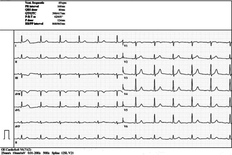 A 12-lead electrocardiogram (ECG) printed on standard grid paper (25 mm/s, 10 mm/mV). The tracing demonstrates a normal sinus rhythm at a ventricular rate of 69 bpm. P waves are present before every QRS complex with a PR interval of 168 ms. The QRS complexes are narrow (80 ms) with a normal axis. In the limb leads (I, II, III, aVR, aVL, aVF), the waveforms show consistent morphology and appropriate polarity. The precordial leads (V1-V6) show expected R-wave progression, with V4-V6 demonstrating prominent R-wave amplitudes. T waves are concordant with the QRS complexes in most leads, though minor T-wave inversion is visible in V1 and V2. Automated measurements provided at the top of the tracing include: Heart rate 69 bpm, PR interval 168 ms, QRS duration 80 ms, QT/QTc 390/417 ms, and P duration 124 ms. This ECG serves as a baseline 'reassuring' study for a patient undergoing immunotherapy, showing no acute ST-segment changes or arrhythmias.