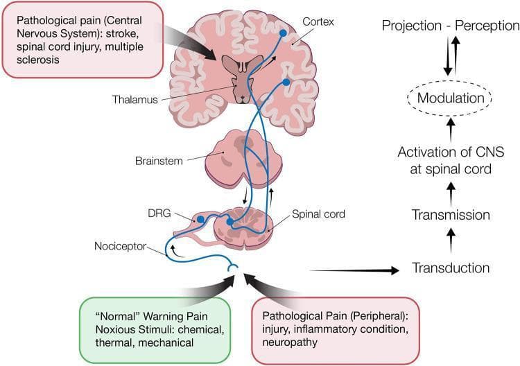 This pathophysiology diagram illustrates the ascending and descending pathways of pain processing in the human nervous system. The visual is divided into an anatomical illustration on the left and a functional flowchart on the right. Anatomical structures shown include peripheral nociceptors, the dorsal root ganglion (DRG), the spinal cord, brainstem, thalamus, and cerebral cortex. The diagram traces the sequence of nociception through four key stages: 1) Transduction (conversion of noxious stimuli like chemical, thermal, or mechanical signals into electrical impulses), 2) Transmission (conduction of action potentials via the DRG to the spinal dorsal horn), 3) Perception (projection of signals through the brainstem and thalamus to the cortex), and 4) Modulation (the enhancement or inhibition of pain signals via descending pathways, represented by a bidirectional arrow). Clinical context is provided through text boxes distinguishing between 'Normal' warning pain and 'Pathological Pain,' citing causes such as inflammation, neuropathy, stroke, spinal cord injury, and multiple sclerosis. This diagram is designed for medical students to understand the neuroanatomy of the pain pathway and the functional distinction between different pain types.
