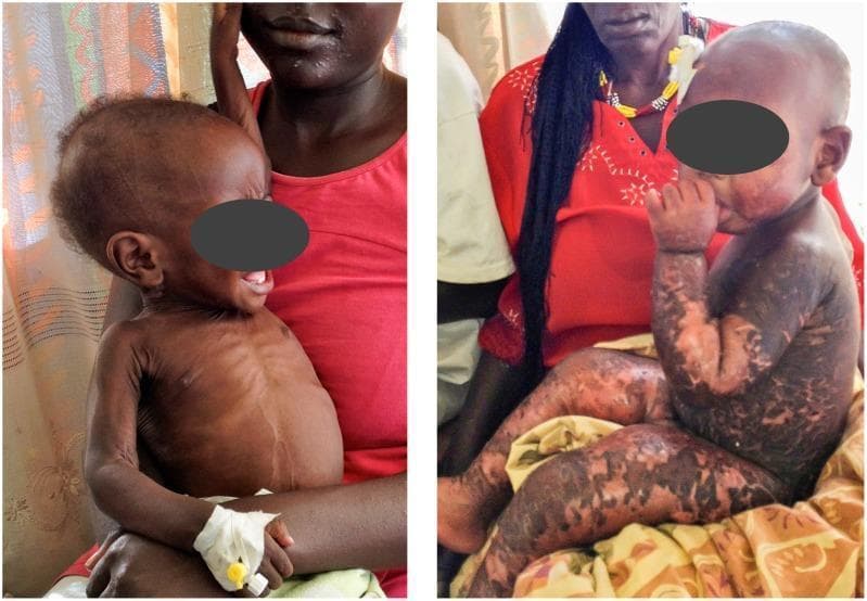 A side-by-side clinical photograph comparing two distinct presentations of severe acute malnutrition (SAM) in pediatric patients. The child on the left demonstrates non-oedematous malnutrition, also known as marasmus. Visual features include marked muscular wasting, loss of subcutaneous fat, and prominent skeletal structures, particularly the ribs. A peripheral venous cannula is secured to the child's left wrist. The child on the right demonstrates oedematous malnutrition, often referred to as kwashiorkor. Key clinical signs include generalized bilateral pitting oedema and extensive dermatological changes. These skin lesions present as a 'flaky paint' dermatosis, characterized by hyperpigmented patches with areas of desquamation, peeling, and underlying hypopigmentation distributed across the limbs and torso. The image serves as a teaching tool for distinguishing between marasmic wasting and the oedematous/skin-involved manifestations of kwashiorkor in global health and pediatric nutrition contexts.