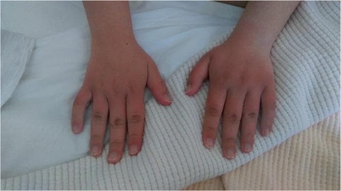 This clinical photograph displays the dorsal surfaces of the hands and fingers in a pediatric or adolescent patient, illustrating characteristic features of acute inflammation or systemic vasculitis such as Kawasaki disease. There is a bilateral, symmetrical distribution of confluent erythema (redness) and non-pitting edema (swelling) affecting the dorsal hands and extending distally to the fingertips. The skin appears taut and shiny, with a loss of normal skin wrinkling over the proximal interphalangeal and metacarpophalangeal joints, indicating significant tissue fullness. This presentation is medically significant as an acute phase physical finding in Kawasaki disease or similar systemic inflammatory syndromes. The erythema is most intense on the digits and dorsal hand, contrasting with the relatively spared skin of the mid-forearms. The educational focus is on identifying common extremity changes during the acute phase of systemic illness, facilitating clinical recognition and diagnostic prioritization.
