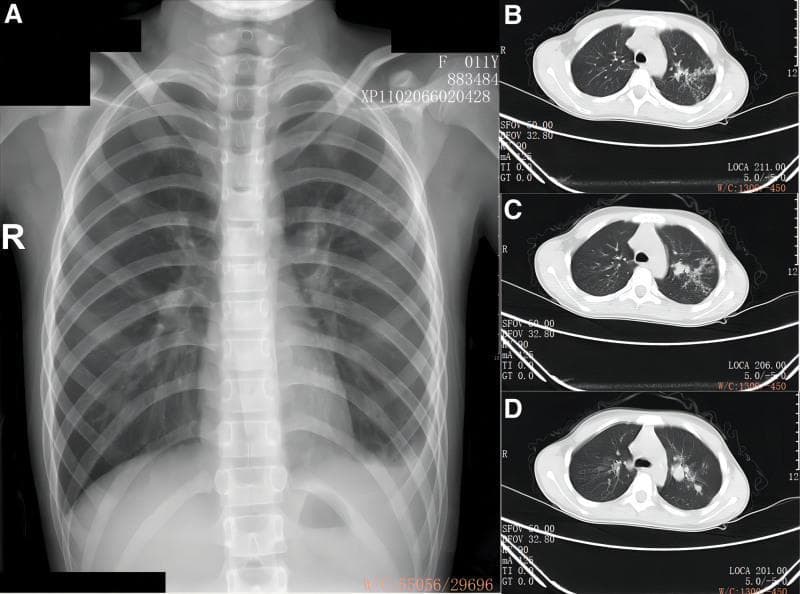 This composite diagnostic image consists of a posterior-anterior (PA) chest X-ray (A) and three axial chest CT scan slices (B, C, D) of a pediatric patient. The chest X-ray shows increased opacity and patchy infiltrates primarily in the mid-to-upper fields of the left lung, accompanied by blunting of the left costophrenic angle suggestive of a small pleural effusion. The axial CT slices (lung window) provide detailed visualization of the left lung pathology, revealing heterogeneous, high-density nodular shadows, tree-in-bud opacities, and areas of consolidation. These findings are concentrated in the left upper lobe and the superior segment of the lower lobe. The right lung appears relatively clear. The clinical context suggests pulmonary tuberculosis with bronchial involvement and tuberculous pleurisy. This image serves as a teaching tool for recognizing multi-modal imaging features of pediatric pulmonary infections and primary tuberculosis manifestations, highlighting the utility of CT in identifying nodular morphology and parenchymal consolidation not fully characterized by radiography.
