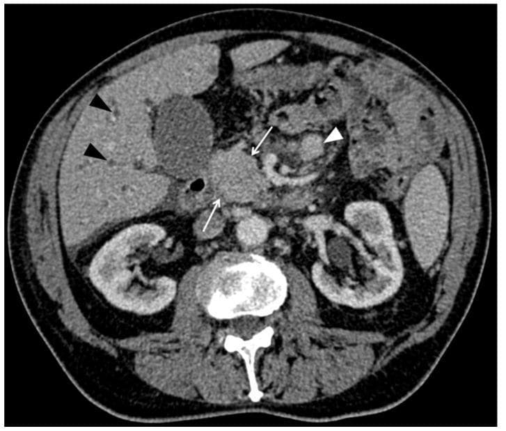 This diagnostic image is an axial contrast-enhanced computed tomography (CT) scan of the abdomen during the portal venous phase. The focal point is a homogeneous, purely solid mass located within the pancreatic head (indicated by white arrows). Associated secondary findings include prominent intrahepatic bile duct dilatation (black arrowheads), suggesting biliary obstruction. An enlarged mesenteric lymph node is also visible (white arrowhead). The image demonstrates signs of peritoneal involvement, notably the presence of ascites within the abdominal cavity. Anatomical landmarks include the liver, gallbladder, both kidneys, and the vertebral body. This case illustrates the radiological presentation of a secondary pancreatic lesion, specifically metastasis (in this clinical context from lung adenocarcinoma), which can mimic primary pancreatic ductal adenocarcinoma but often presents with distinct imaging characteristics such as well-defined margins and varying degrees of ductal dilatation.