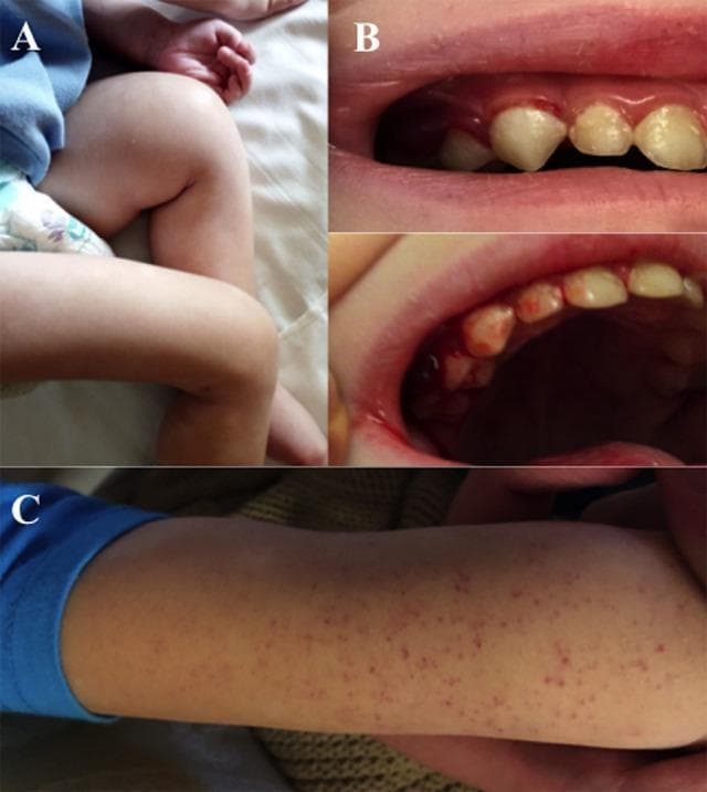 This composite of clinical photographs illustrates the classic mucocutaneous and musculoskeletal manifestations of pediatric scurvy (Vitamin C deficiency). Image A displays the lower extremities of a child, showing significant swelling and edema of the left thigh and knee area, with the limb held in a flexed, antalgic posture due to subperiosteal hemorrhage and bone pain. Image B consists of two intraoral views showing severe gingival hyperplasia, spongy swelling, intense erythema, and active friable bleeding along the gingival margins, particularly around the erupting primary teeth. Image C shows a close-up of an extremity featuring a diffuse distribution of pinpoint, non-blanching petechial hemorrhages across the skin surface. Collectively, these findings represent the clinical triad of hemorrhagic diathesis (petechiae and bleeding gums), skeletal changes (painful limb swelling), and nutritional deficiency. The images are highly relevant for pediatrics and hematology, demonstrating the physical exam signs of defective collagen synthesis and impaired capillary integrity.