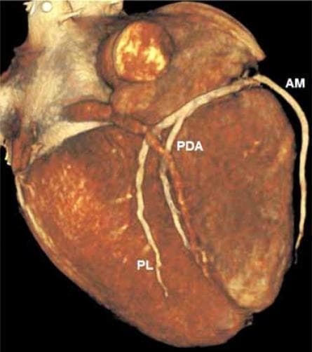 This diagnostic image is a 3D surface-rendered reconstruction of a human heart, specifically focused on the inferior surface to demonstrate coronary arterial anatomy. The rendering shows a reddish-brown textured myocardium with prominent vasculature. The image illustrates a right-dominant coronary circulation system, highlighting the distal branches of the right coronary artery (RCA). Three key arterial branches are annotated: the Acute Marginal (AM) artery curving along the right ventricular margin, the Posterior Descending Artery (PDA) coursing within the posterior interventricular sulcus toward the apex, and a Posterolateral (PL) branch extending toward the diaphragmatic surface of the left ventricle. This visualization is characteristic of Cardiac Computed Tomography Angiography (CCTA) and is used in clinical cardiology to assess coronary artery patency, anatomical variations, and the presence of atherosclerotic disease. The educational focus is on identifying posterior cardiac landmarks and understanding the distribution of blood supply in a dominant right coronary system.