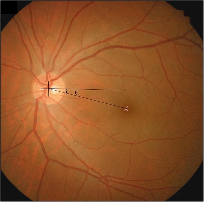 This clinical photograph is a fundus image of a human retina, demonstrating the disc-foveal method for assessing ocular torsion. The image shows a healthy reddish-orange retinal background with the optic disc positioned on the left and retinal blood vessels radiating outward in a normal branching pattern. A crosshair is centered on the optic disc, and a white 'X' marks the location of the fovea centralis within the macula. A geometric overlay illustrates the disc-foveal angle, labeled with the Greek letter 'θ' (theta). This angle is defined by a horizontal reference line extending from the center of the optic disc and a second line connecting the center of the optic disc to the fovea. This measurement is clinically significant in ophthalmology for quantifying excyclotorsion or incyclotorsion, particularly in patients with superior oblique muscle palsy or other forms of paralytic strabismus. The image serves as an educational tool for diagnostic imaging and surgical planning in strabismus management.