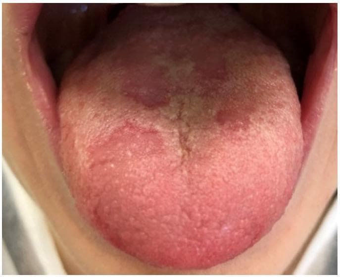 This clinical intraoral photograph displays the dorsal surface of the tongue in an 11-year-old patient, demonstrating classic features of geographic tongue, also known as benign migratory glossitis. The image shows multiple, well-demarcated, erythematous patches resulting from the atrophy of filiform papillae. These smooth, red zones contrast sharply with the surrounding healthy mucosa, which appears more textured and pinkish-white due to intact papillae. Some of the erythematous areas are bordered by slightly elevated, yellowish-white circinate lines. The lesions are distributed irregularly across the anterior and middle portions of the tongue, exhibiting the characteristic map-like or 'geographic' appearance. There is no evidence of ulceration or acute inflammation beyond the papillar atrophy. This condition is a common pediatric oral mucosal lesion and is often diagnosed clinically based on its migratory nature and unique morphology. It is used in dental and medical education to illustrate benign inflammatory disorders of the tongue and the visual presentation of papillary loss.