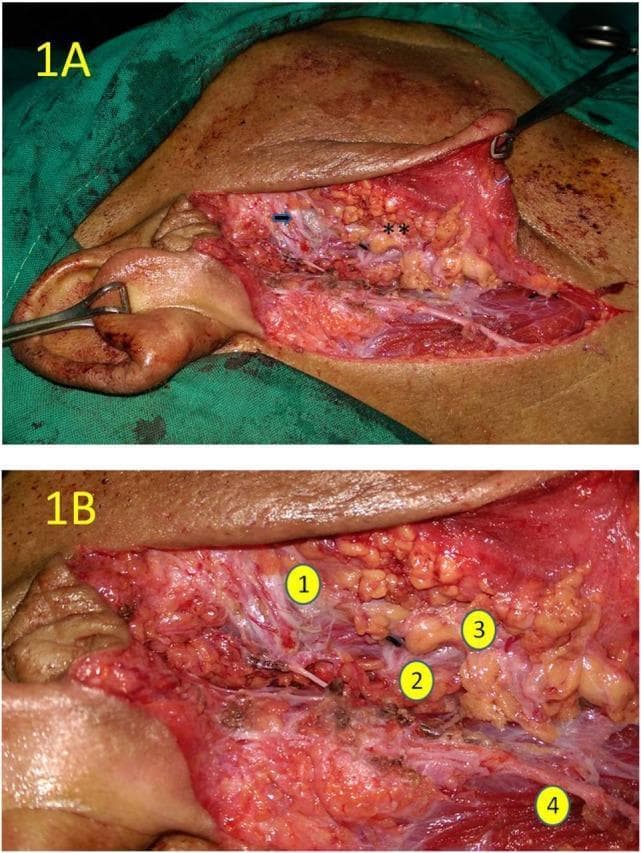 Clinical intraoperative photograph of a right quadrant parotidectomy, presented in two panels (1A and 1B). Panel 1A provides a wide surgical field view showing the post-excision anatomy of the upper quadrant. A blue arrow identifies the skeletonized zygomatic branch of the facial nerve, while a double asterisk marks the rough, nodular transected surface of the lower parotid gland quadrant. Panel 1B is a high-magnification close-up view identifying key neurovascular and glandular landmarks: (1) the zygomatic branch of the upper trunk of the facial nerve, appearing as a thin, white fiber; (2) the origin of the lower trunk of the facial nerve; (3) the yellowish, lobulated parenchyma of the transected lower quadrant; and (4) the great auricular nerve located inferior to the primary surgical site. The images demonstrate the surgical preservation of the facial nerve trunk and its branches during selective salivary gland resection. This material is suited for teaching surgical anatomy, parotid surgery techniques, and nerve-sparing protocols in otolaryngology or surgical oncology.